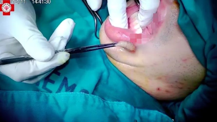 經由手術為陳先生取出馬蠅幼蟲。（馬偕醫院提供）