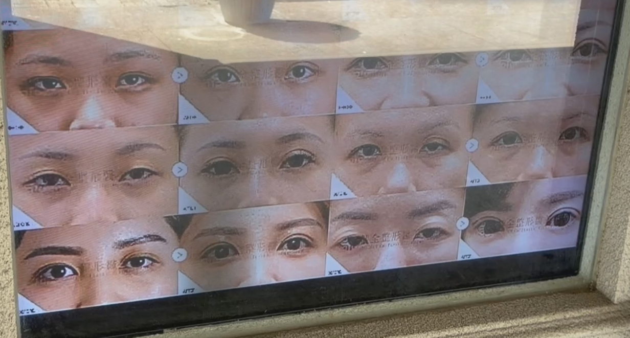 女醫美割眼袋竟奪命　家屬怒告診所醫療疏失1／45歲女房仲割眼袋　麻醉後不適急救11天身亡