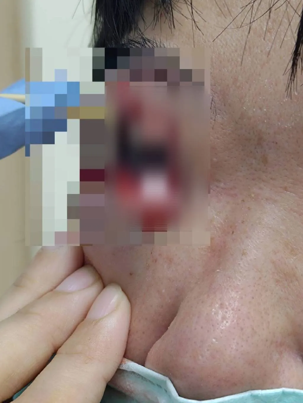 一句「請回去坐好」  特教生持斷掃把戳女代課老師眼睛大失血近失明
