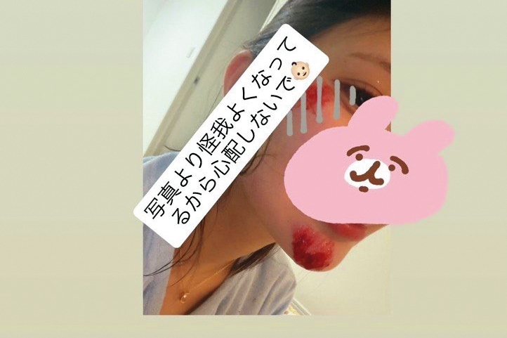 流出的對話截圖中,倉木華曾貼出自己的臉部傷勢,控訴事故後平良翔太避不處理。(翻攝自倉木華IG)