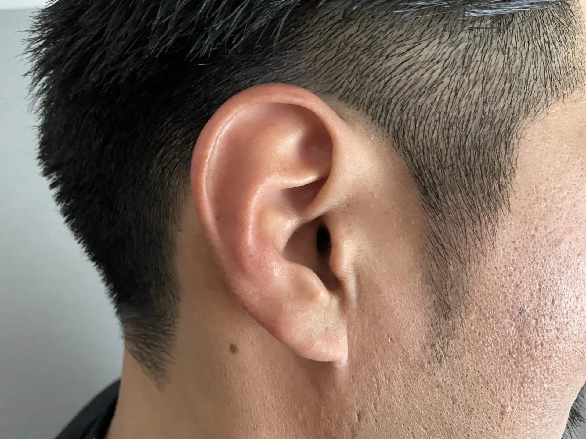 20多歲男「凸一根」！耳朵長肉柱忍5年才就醫　醫警告：會愈長愈大