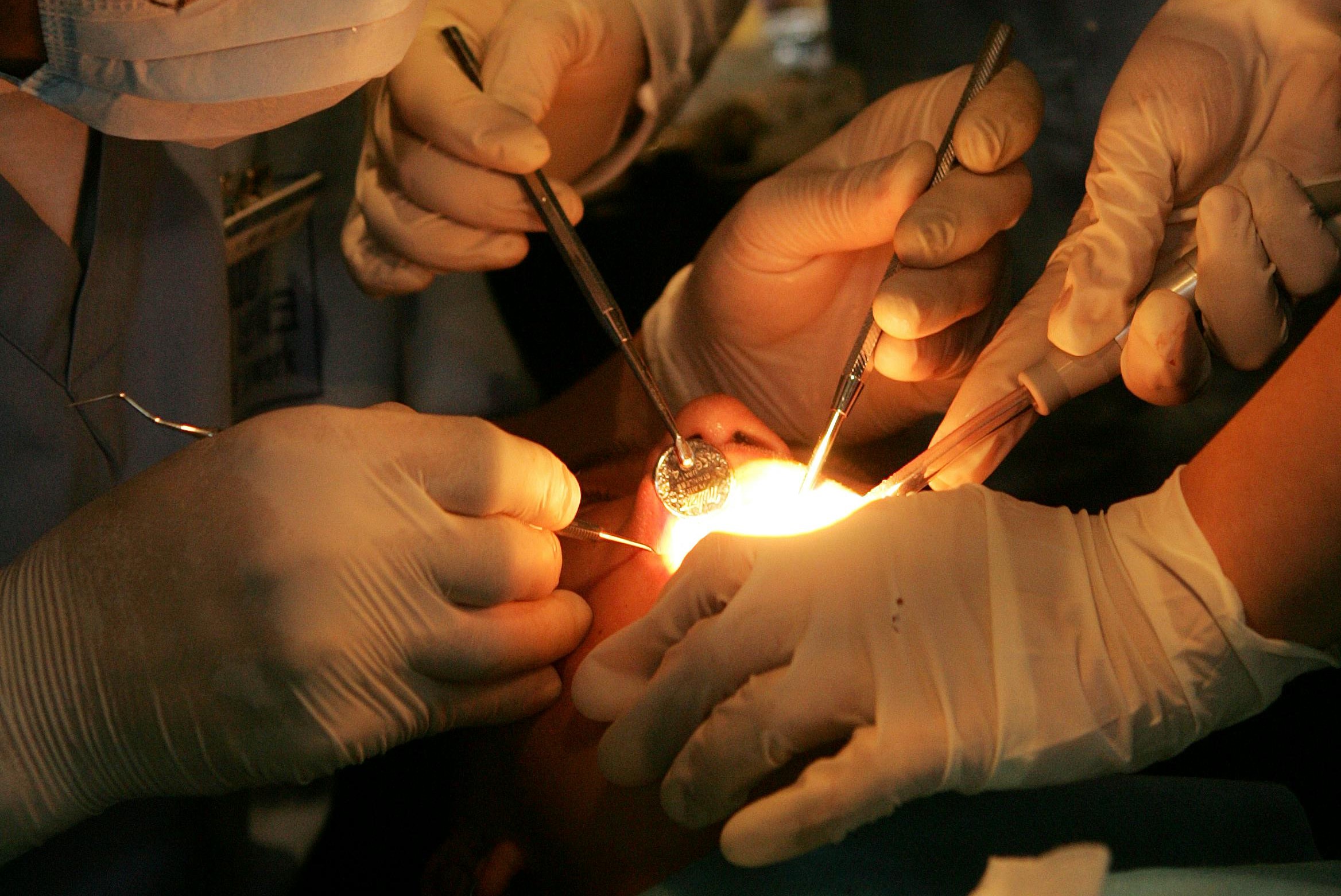 英國男子帕維爾赴土耳其進行全口植牙,卻因診所未提供臨時假牙,導致其面臨長達半年的無牙痛苦。(示意圖,非當事人/pexels)