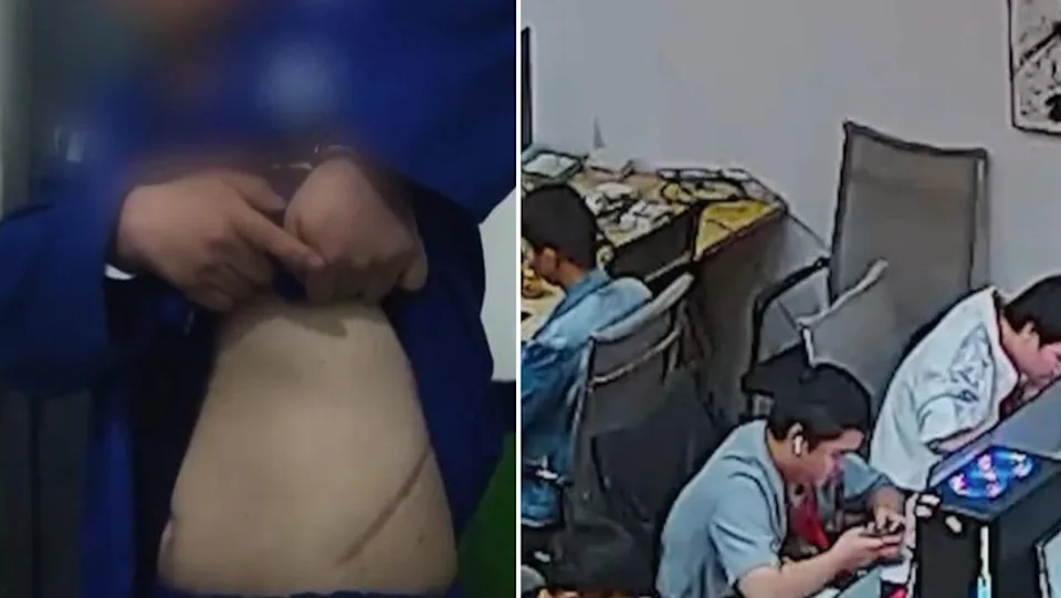 業績達不到被逼「割腎抵債」！緬甸豬仔揭詐騙園區黑幕　撩衣曬30公分傷疤：被當商品轉賣