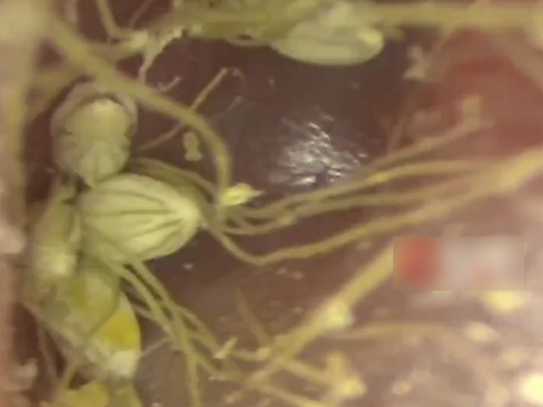 一名1歲幼童因頻繁抓耳朵就醫,醫師檢查發現耳道深處竟有多顆發芽種子,隨後緊急進行全麻手術將異物完整取出。(翻攝自瀟湘晨報)