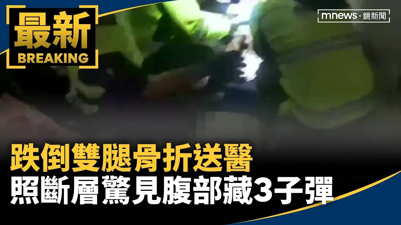 跌倒雙腿骨折送醫　照斷層驚見腹部藏3子彈