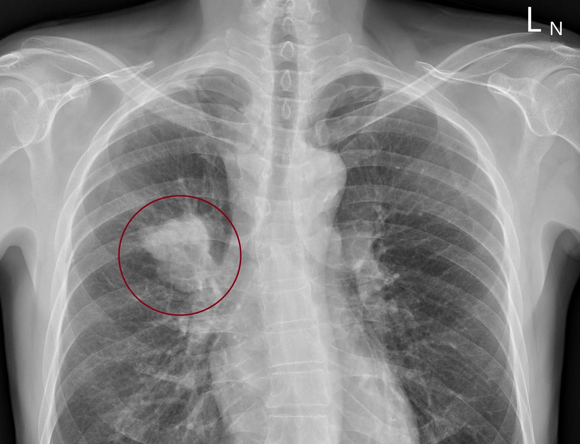 男子脖子下方出現凸起物,就醫檢查竟發現癌細胞早已擴散。(翻攝自蘇一峰臉書)