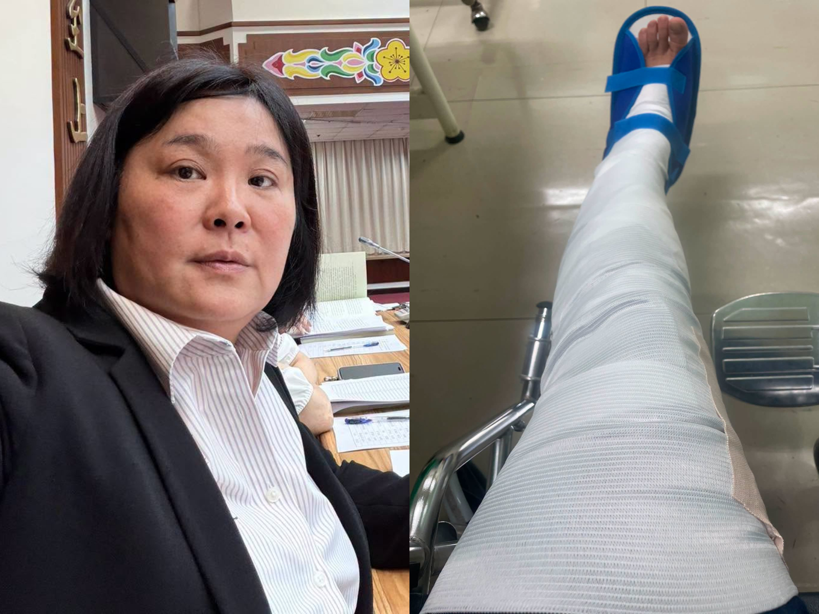 陳玉珍左腳打上石膏,她表示近日行程將延期或取消。(翻攝自陳玉珍臉書)