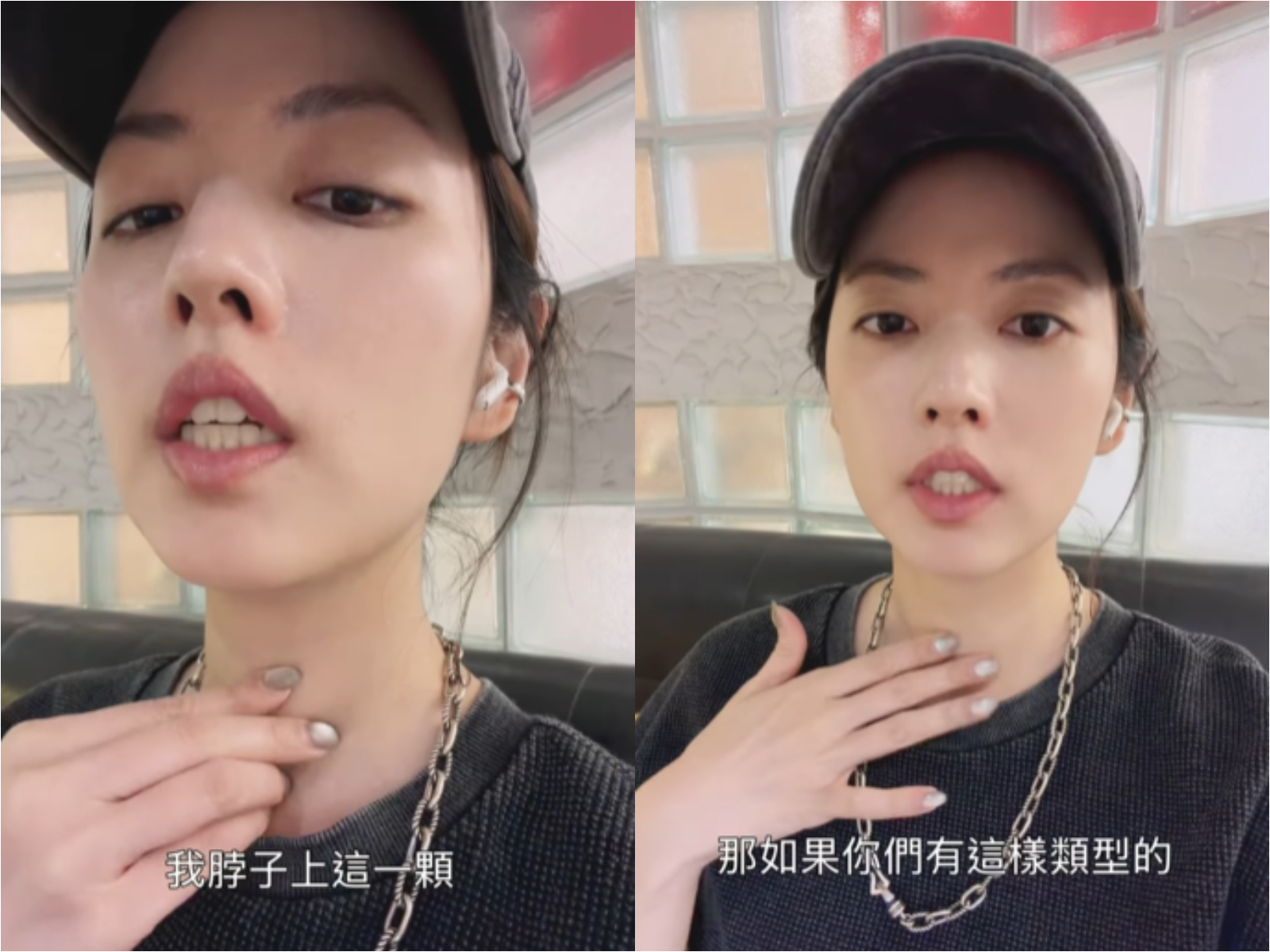 阿諾曝頸部腫塊「消了又長」 甲狀腺結節良性將做手術