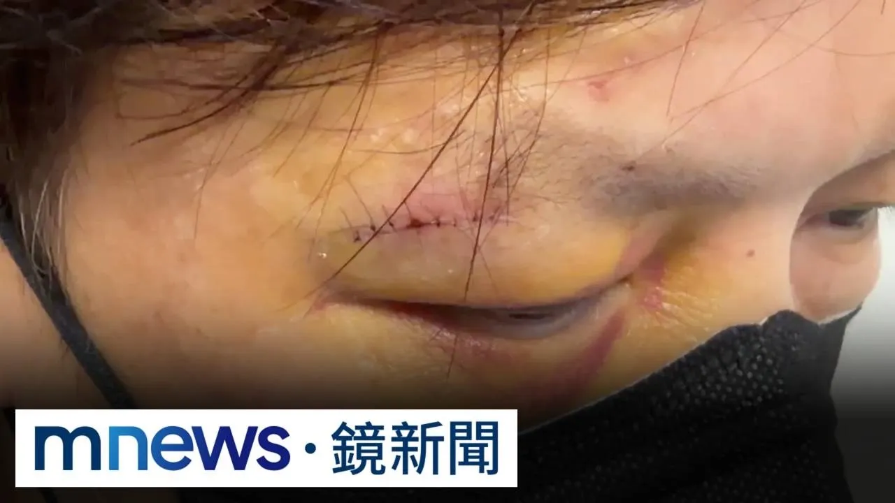 天外飛來戰鬥陀螺「發射器」砸臉　男破相縫近20針