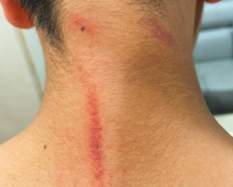 B生對小凱施暴,導致小凱的背、頸部受傷。(讀者提供)